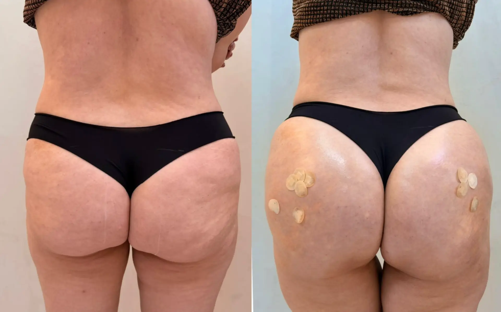 Antes e depois da harmonização glútea Bumbum Bella