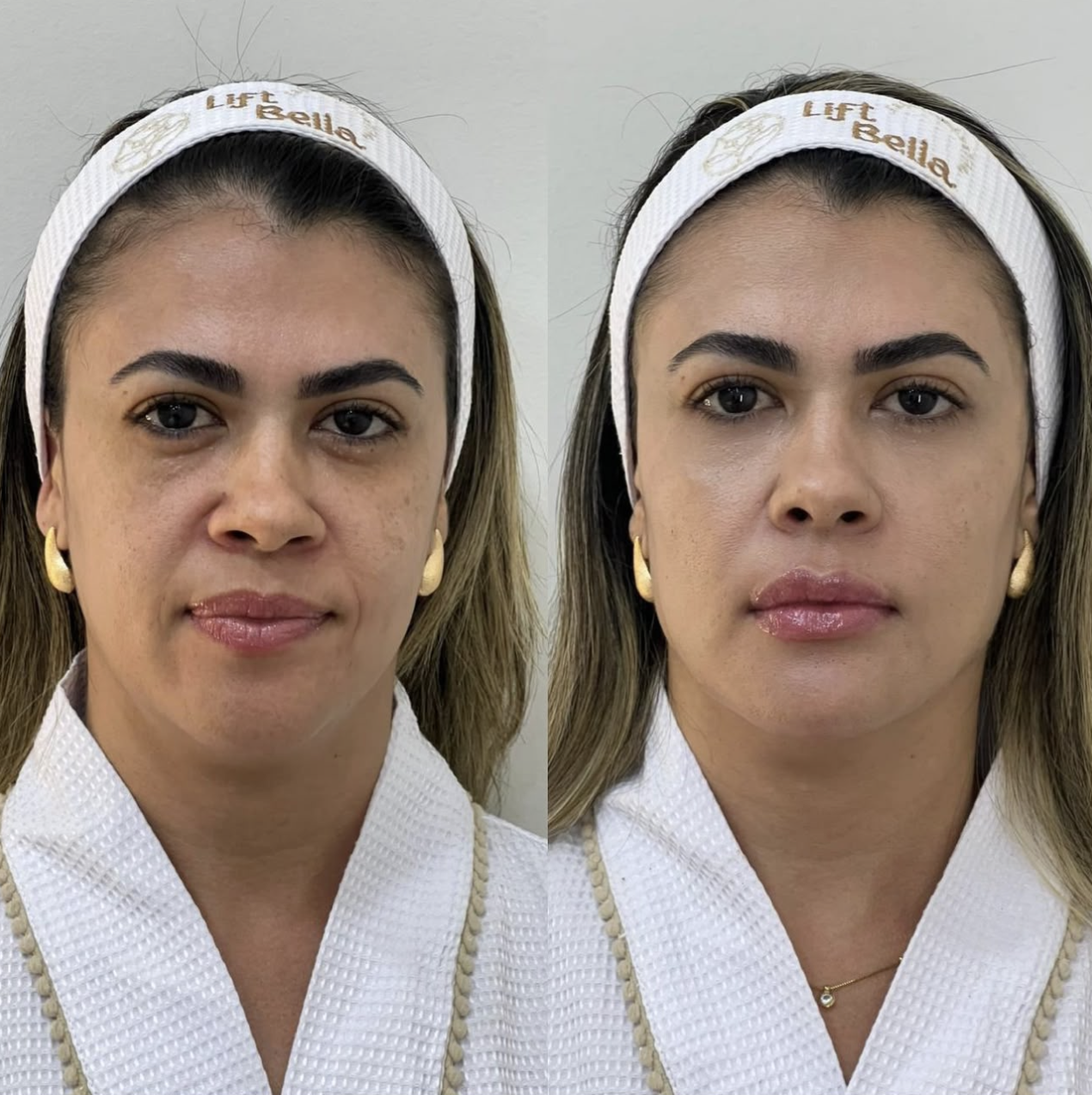 Antes e depois de harmonização facial com a técnica Sculpt Bella