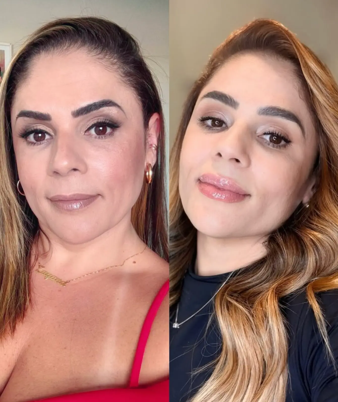 Antes e depois de harmonização facial com a técnica Sculpt Bella