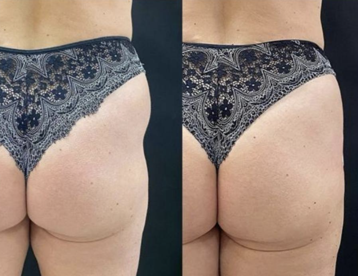 Antes e depois de harmonização glútea com o protocolo Bumbum Bella