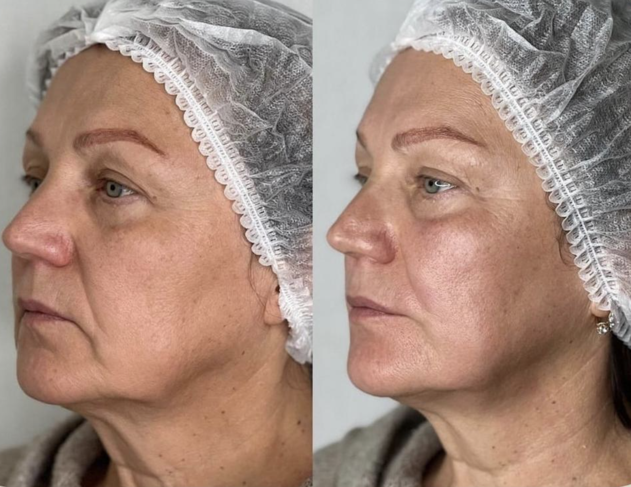 Antes e depois de harmonização facial com a técnica Sculpt Bella