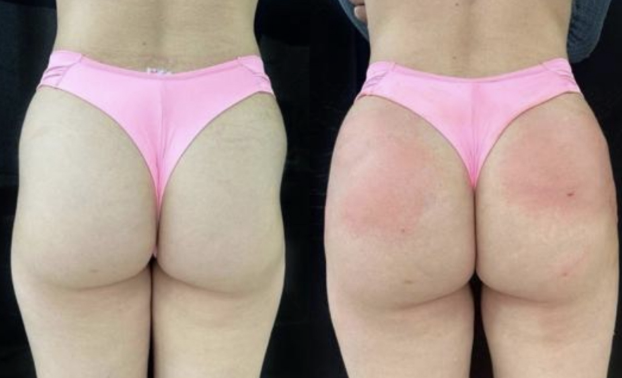 Antes e depois de harmonização glútea com o protocolo Bumbum Bella