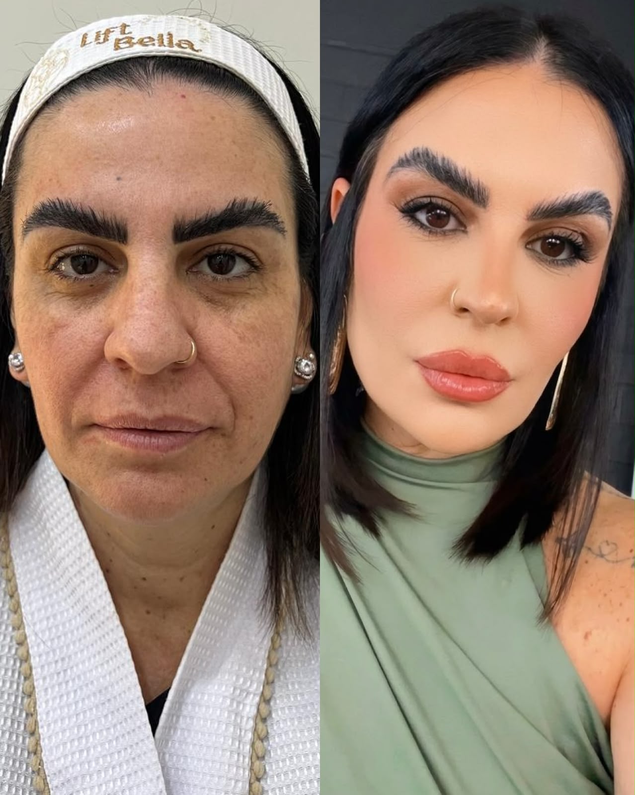 Antes e depois da harmonização facial Sculpt Bella
